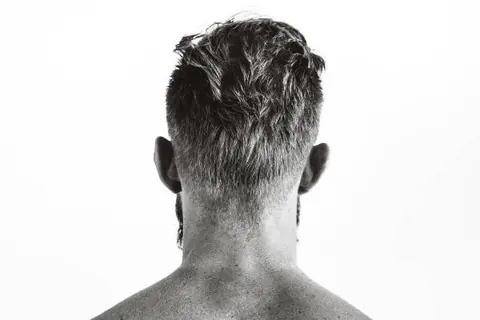 Do I need finasteride hair transplant back of man's head