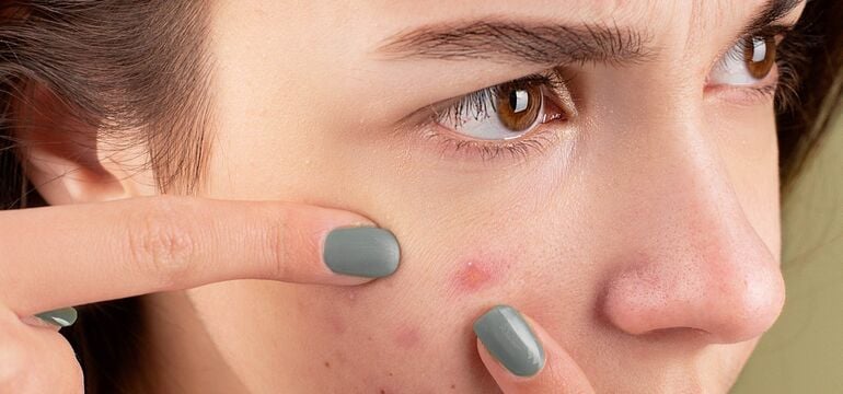 Acne treatment with Duac gel and Lymecycline capsules