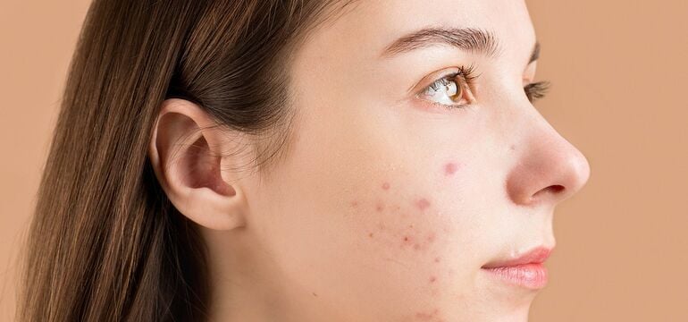 Billiges Roaccutane