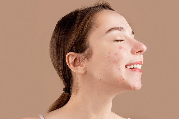 Lymecycline side effects