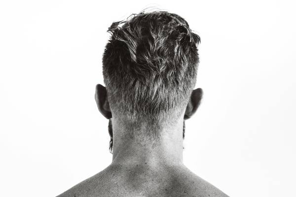 Do I need finasteride hair transplant back of man's head