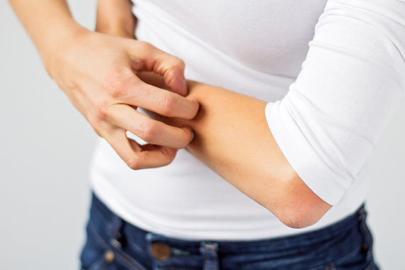 Eczema Treatments